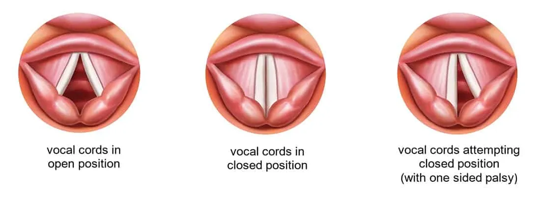 Ilustración de parálisis de cuerda vocal